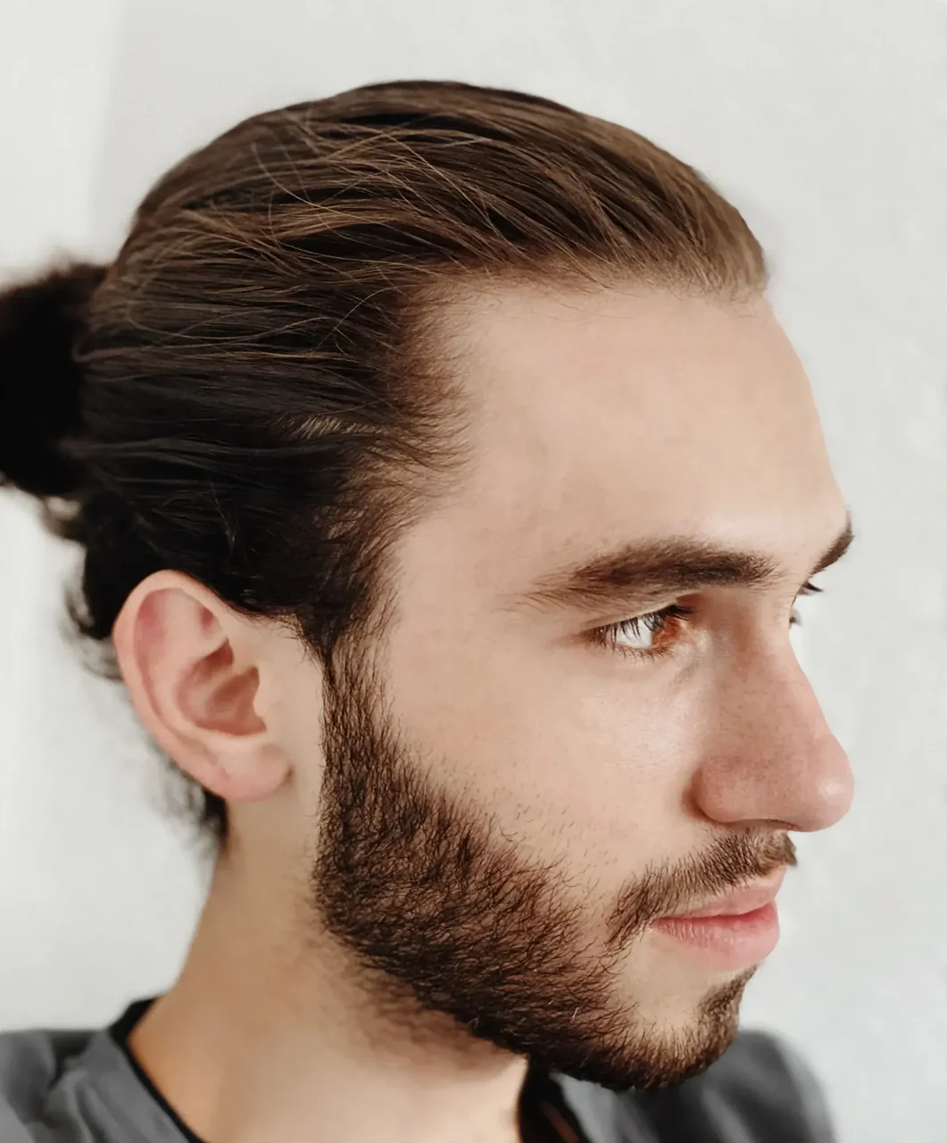 After: Beard transplant · patchy beard