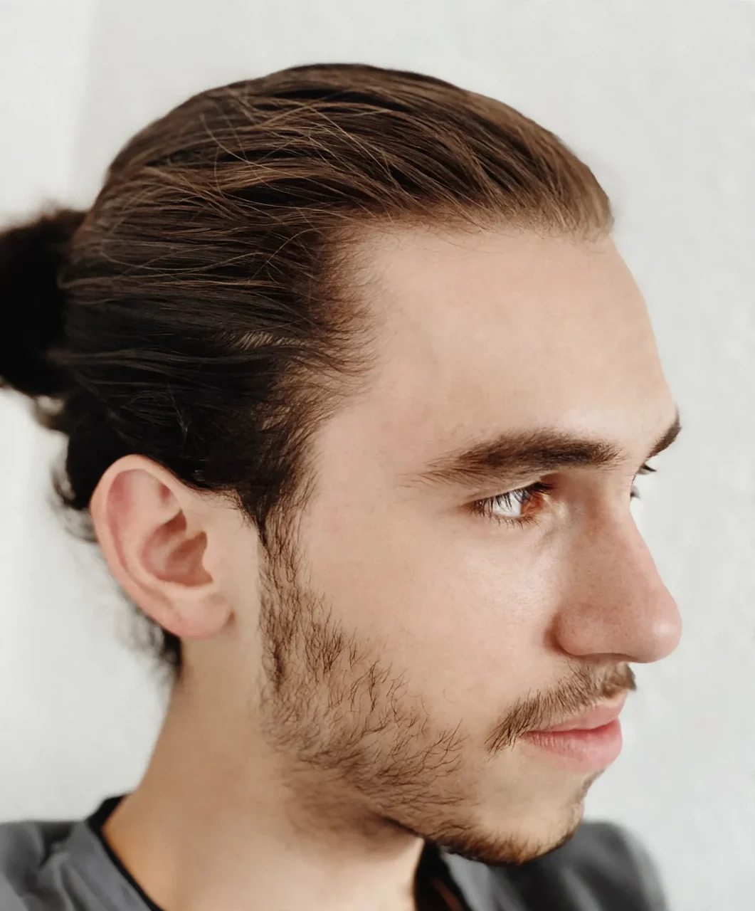 Before: Beard transplant · patchy beard