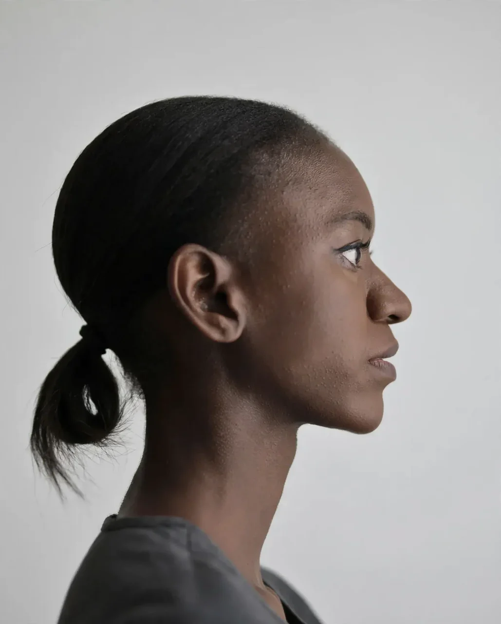 After: Chin filler, profile