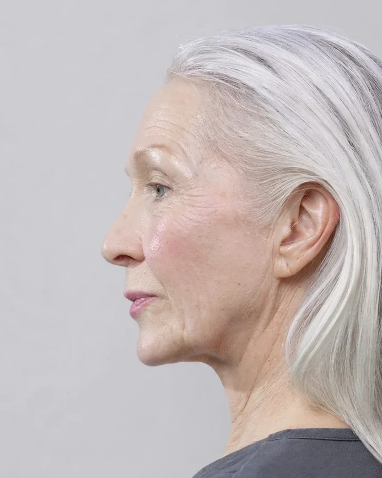 Before: Face and neck lift · profile