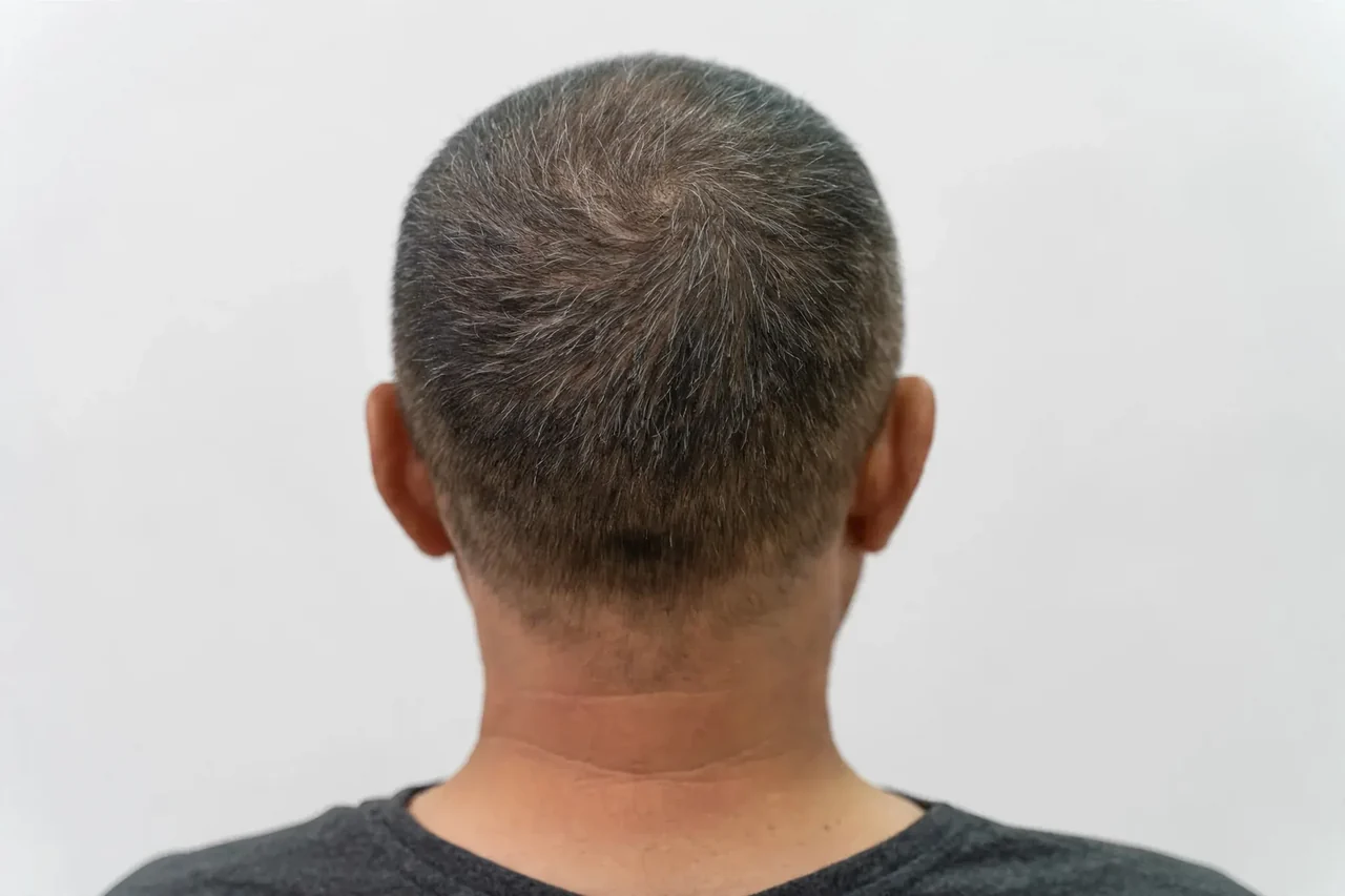After: Hair transplant · crown