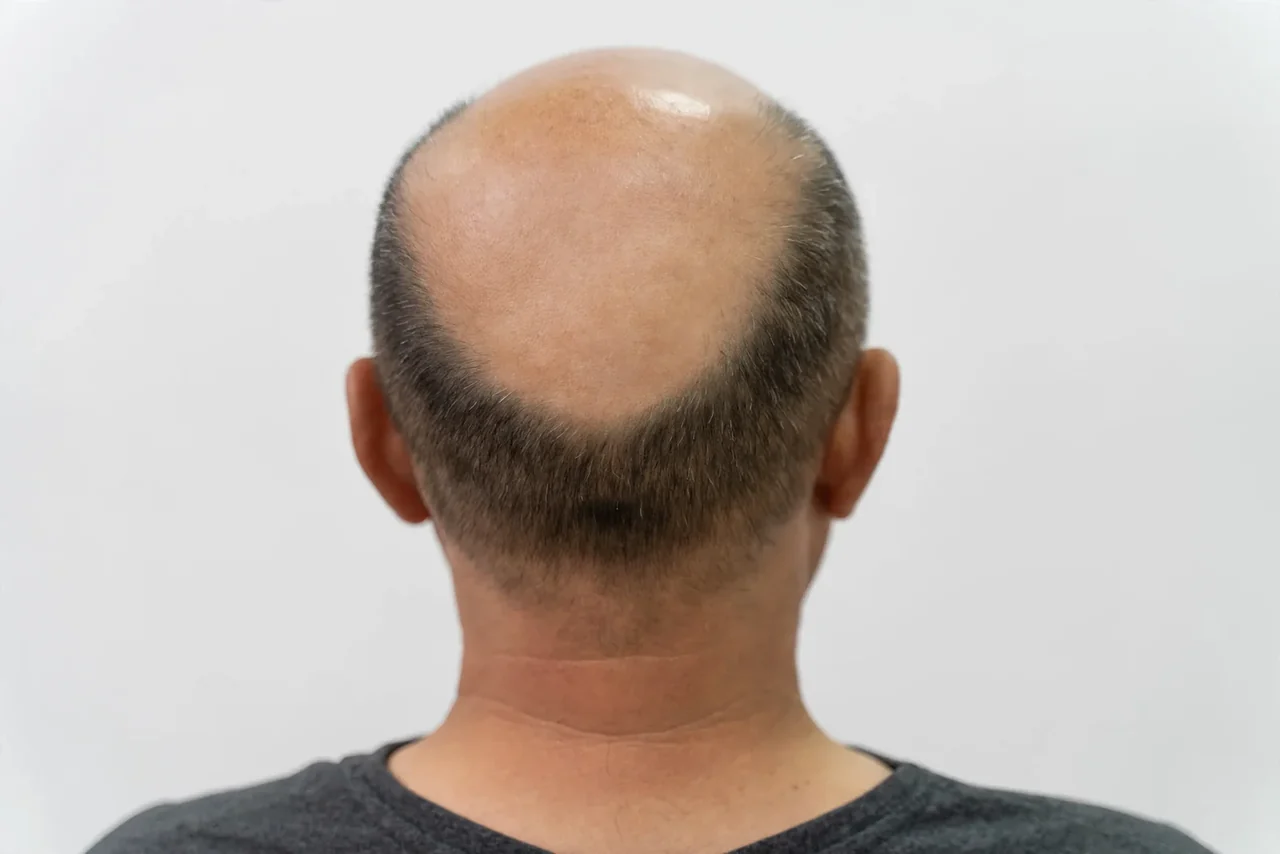 Before: Hair transplant · crown
