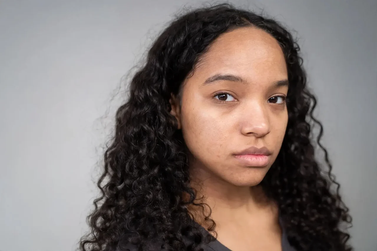 After: Microneedling · acne marks