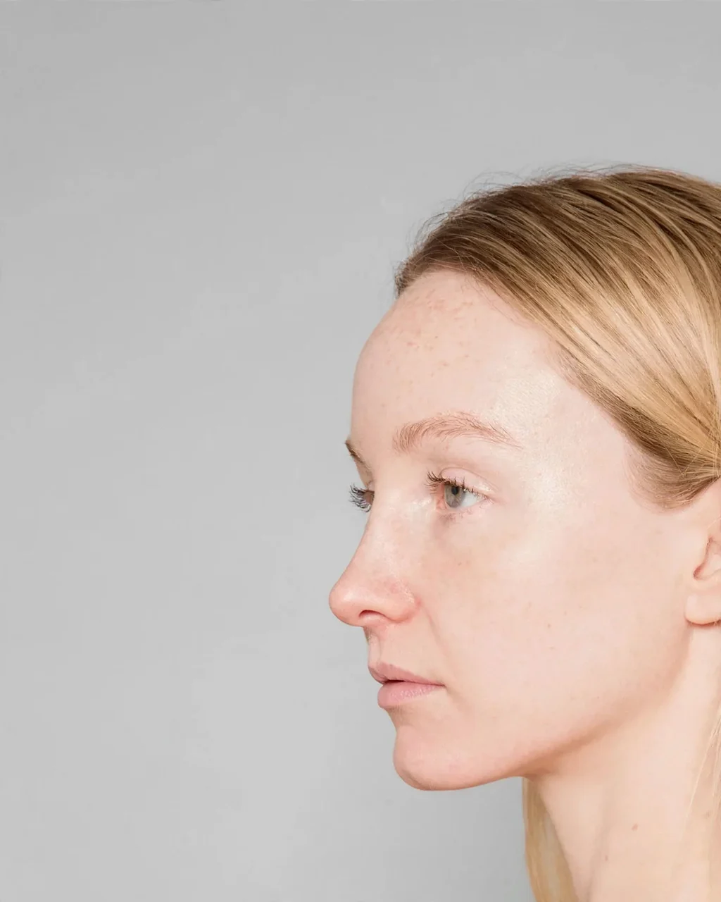 After: Rhinoplasty · profile